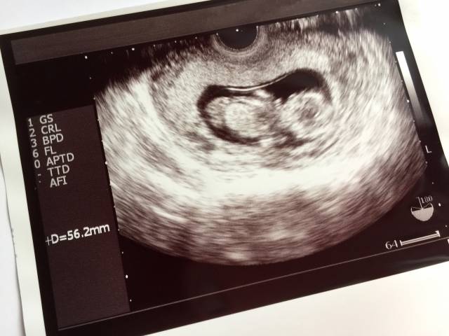 妊娠11週頃のエコー写真｜写真素材なら「写真AC」無料（フリー）ダウンロードOK (111358)